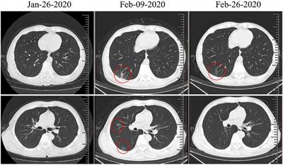 Case Report: A Nasopharyngeal Cancer Patient Got COVID-19 During Radiochemotherapy in Wuhan